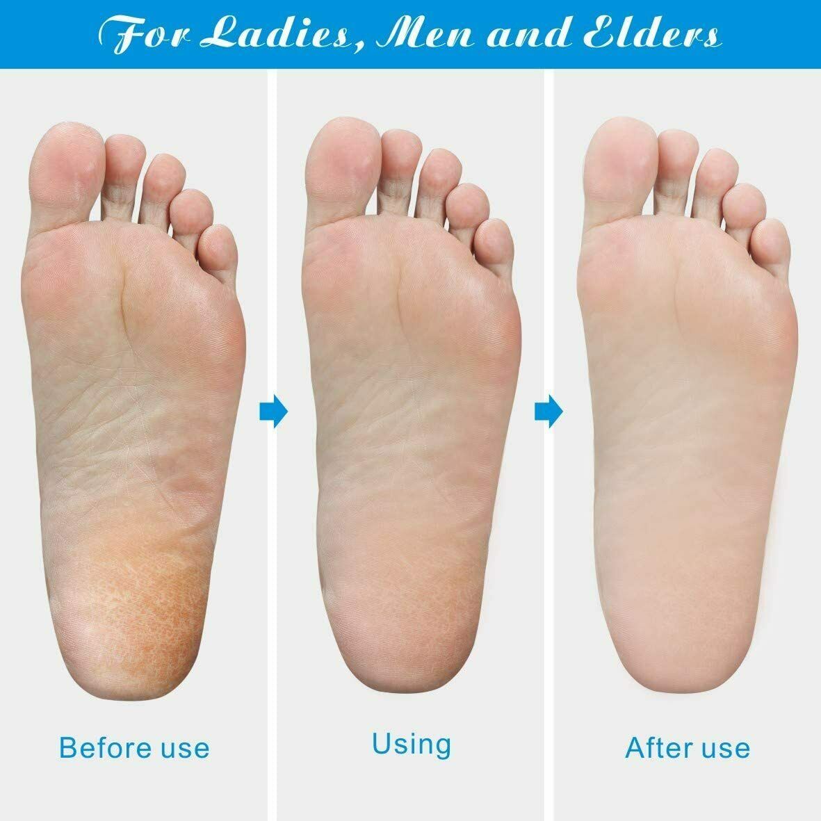 "Professional Foot Callus Remover & Pedicure Tool"